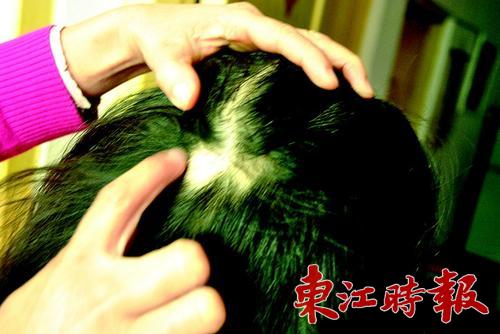 晓彤头上有一块头皮裸露没长头发