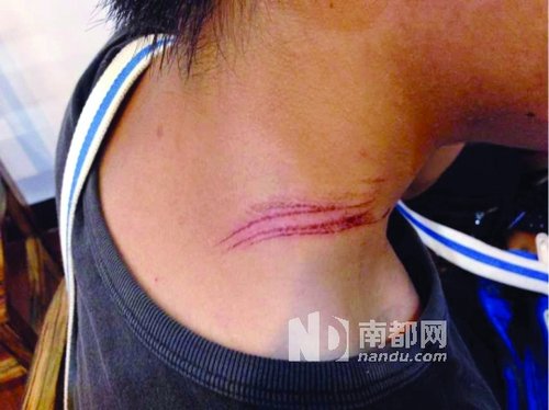 江门小伙骑车上班途中 被风筝线缠绕割伤脖子